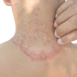 Close-up of a person's neck showing a skin rash