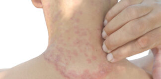 Close-up of a person's neck showing a skin rash