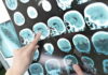 Kids Walk Again After ‘Fatal’ Diagnosis A healthcare professional pointing at brain scan images showing signs of a stroke