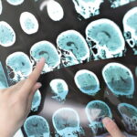 A healthcare professional pointing at brain scan images showing signs of a stroke