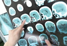 A healthcare professional pointing at brain scan images showing signs of a stroke
