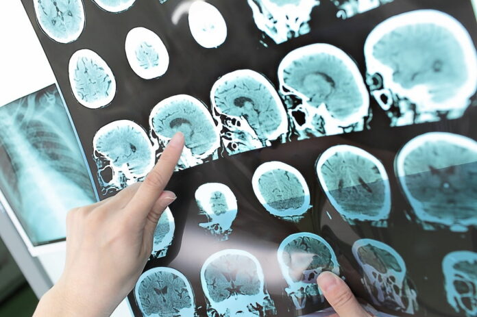 A healthcare professional pointing at brain scan images showing signs of a stroke