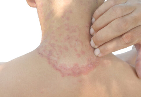 Close-up of a person's neck showing a skin rash