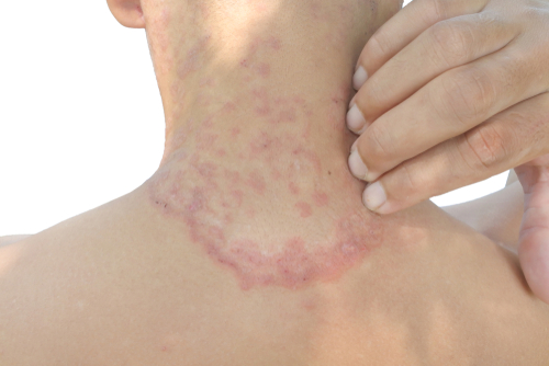 Close-up of a person's neck showing a skin rash